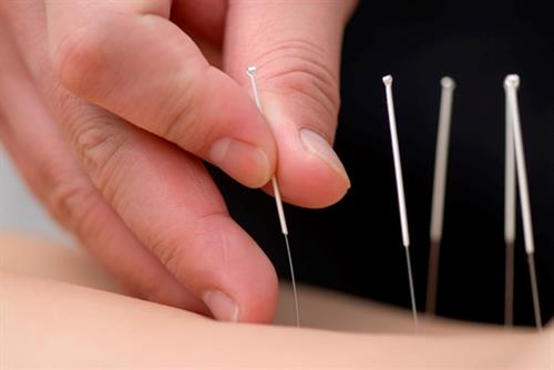 Community Acupuncture Time